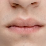 Az arcpattanások okai – arc térkép: hogyan olvashatók az arc jelei a bőrünk állapotáról